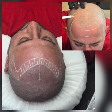 Kopfhautpigmentierung im Prozess